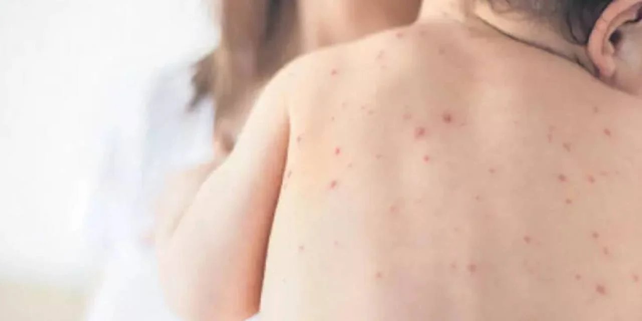 Sağlık Bakanlığı'ndan 81 il valisine 'Kızamık için önlem alın' yazısı gitti, Türk Tabipleri Birliği: 'Nihayet kabul ettiler'