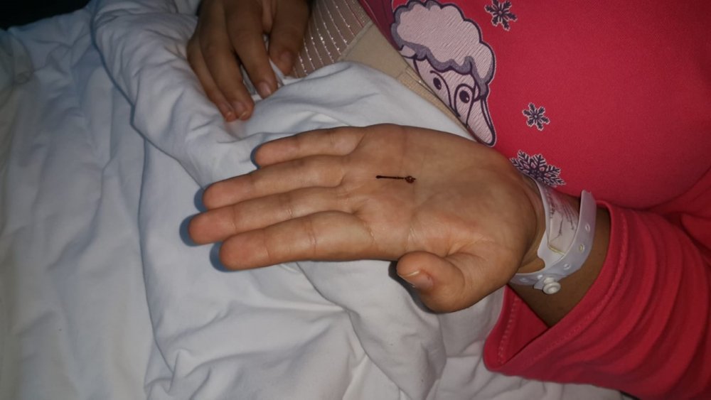 1 yaşında yuttuğu toplu iğneden 18'inde kurtuldu