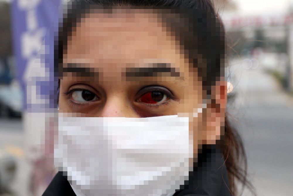 2,5 aylık eşi tarafından darbedilen Sudenya: Korktuğum için evden çıkamıyorum