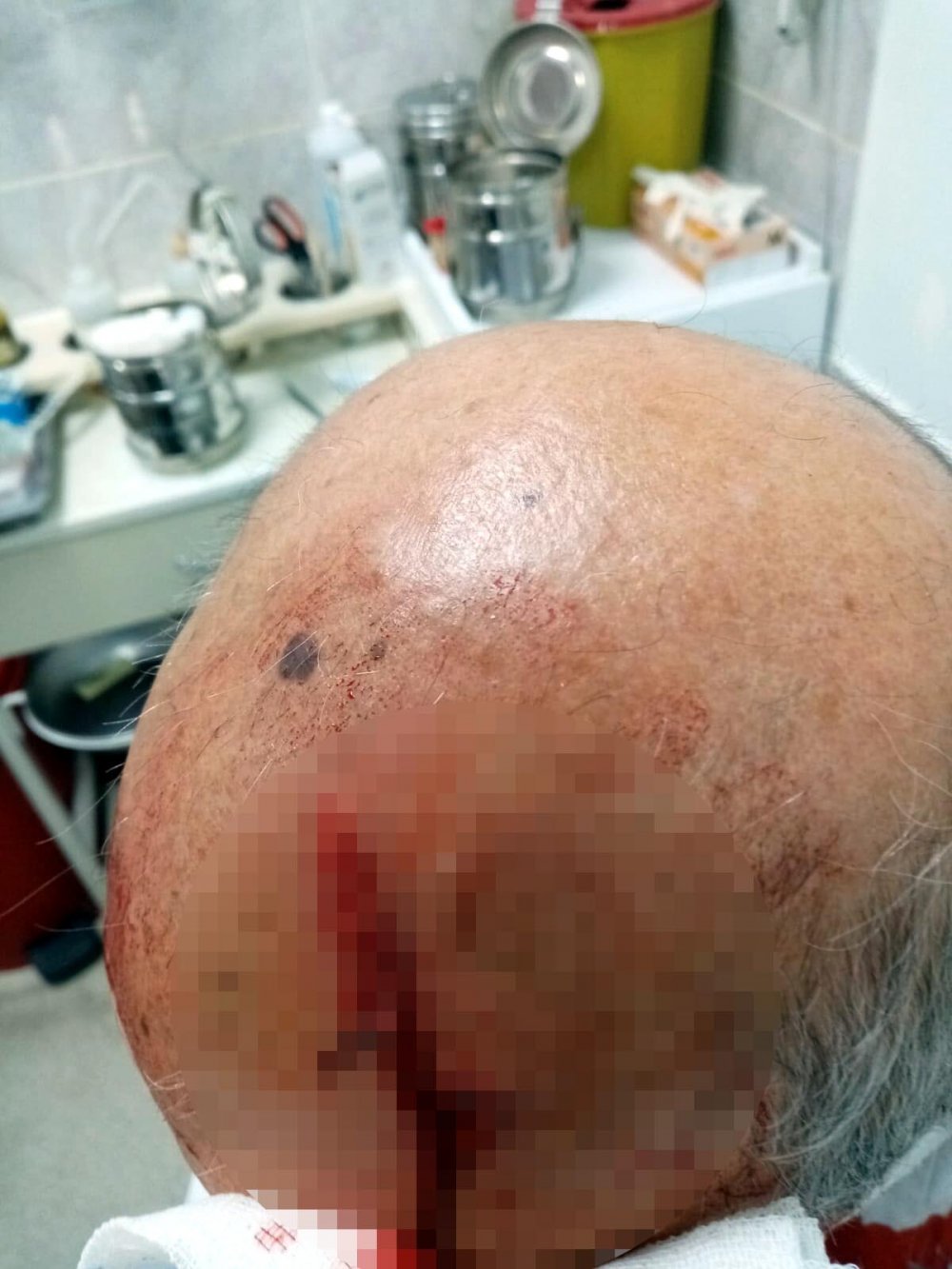 Yarılan kafasına meslektaşı oğlu tarafından 8 dikiş atılan Mutlugüleçler, şikayetçi oldu: Maske uyarısı yapan doktora taşlı saldırı
