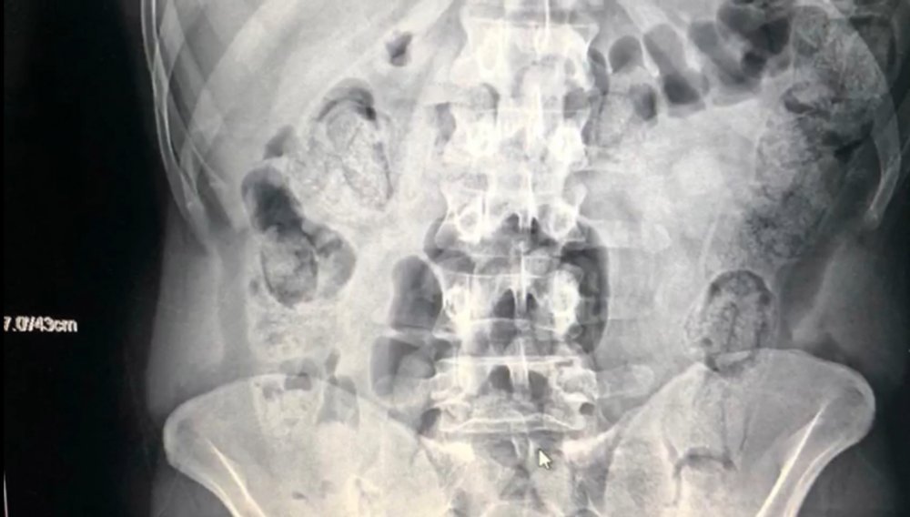 İranlı yolcuların midesinden 871 gram metamfetamin çıktı
