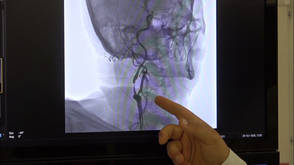 'Koronavirüs hastalarının 3'te 1'inde beyin ve sinir sistemi ciddi şekilde etkileniyor'