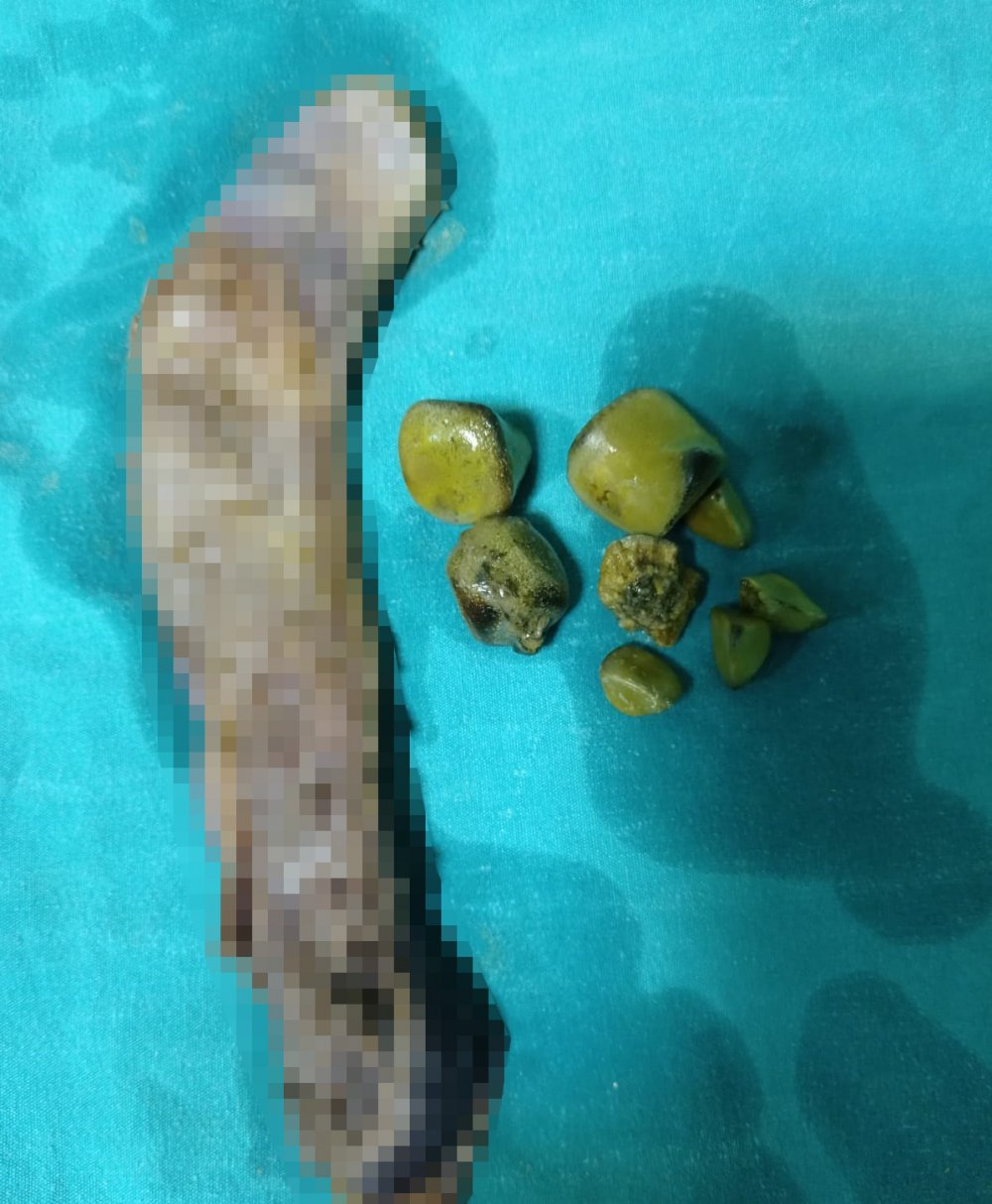 'DÜNYA ÇAPINDA TIP LİTERATÜRÜNDEKİ İKİNCİ VAKA': 30 santimlik safra kesesi dünya tıp literatürüne girdi