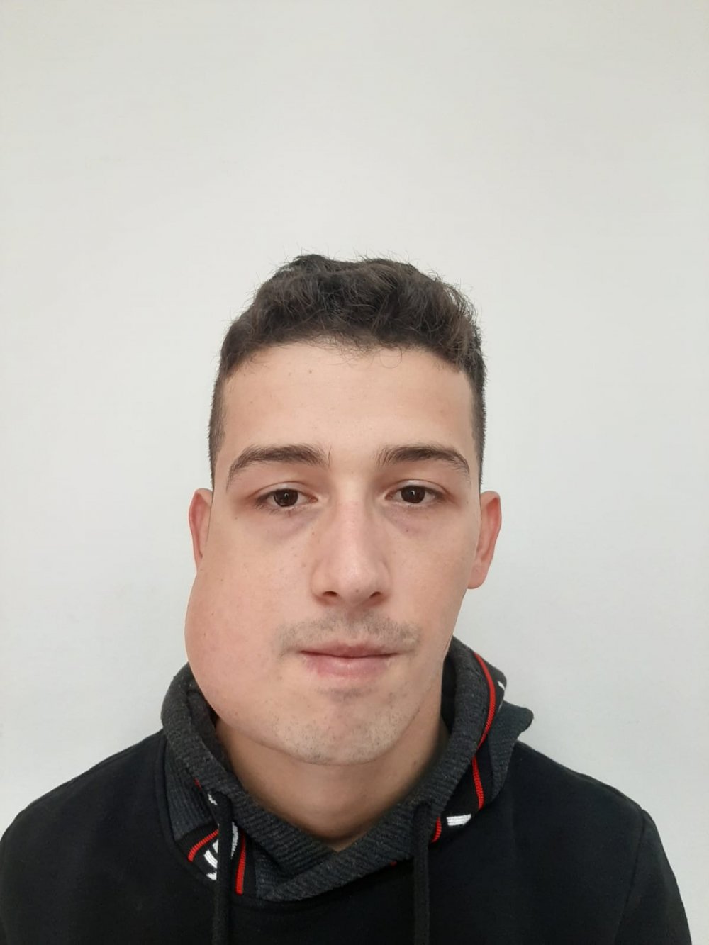 Yüzündeki dev tümörden “sanal ameliyat” ile kurtuldu