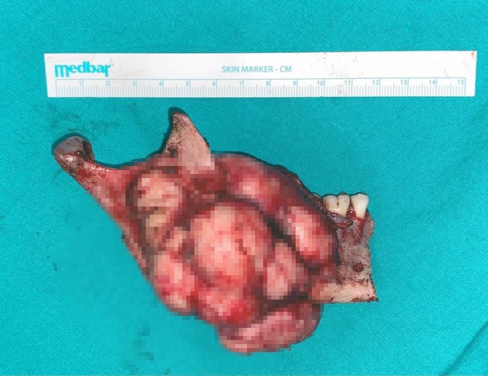Yüzündeki dev tümörden “sanal ameliyat” ile kurtuldu