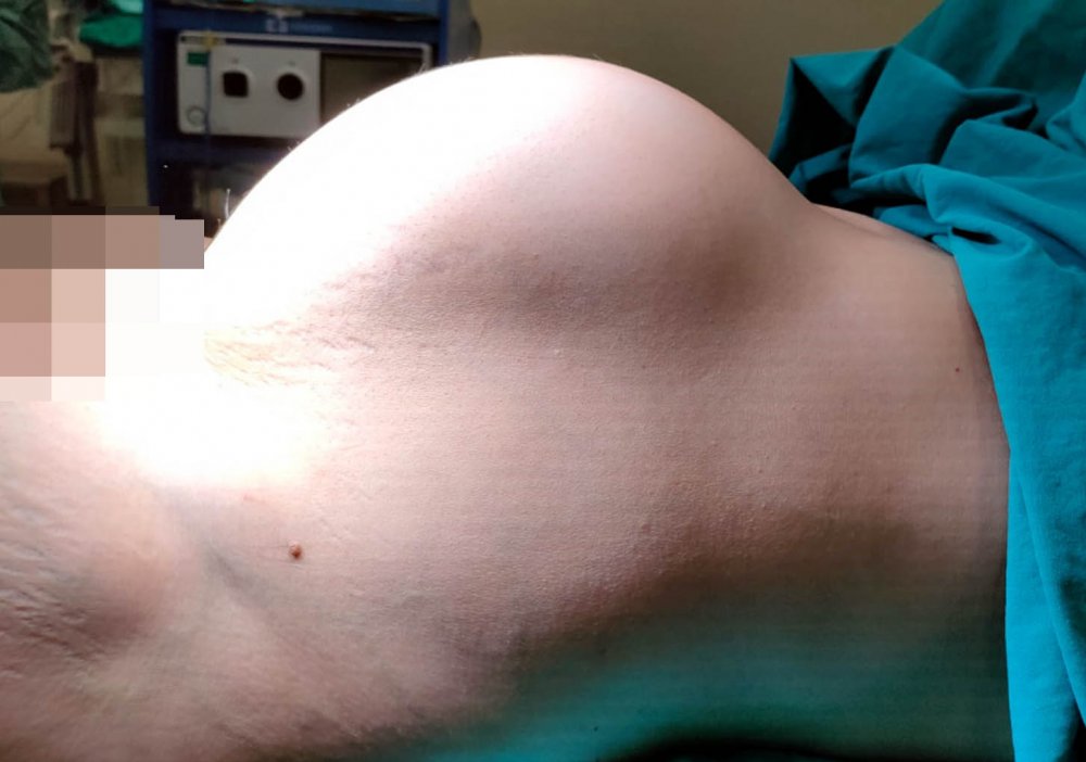 Karnı ağrımaya başlayınca hastaneye gitti; 9 kilo 600 gram ağırlığında tümör çıkartıldı