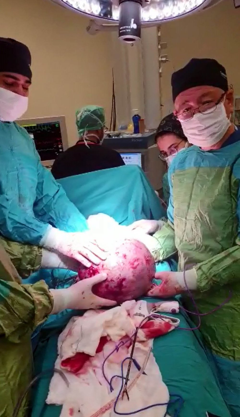 Karnı ağrımaya başlayınca hastaneye gitti; 9 kilo 600 gram ağırlığında tümör çıkartıldı