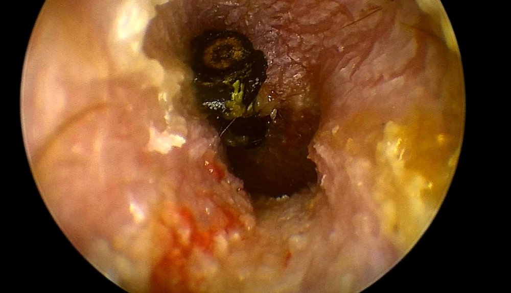 Kulaklardan çıkanlar hayrete düşürüyor