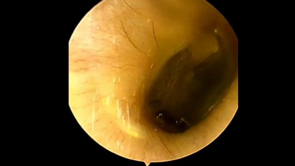 Kulaklardan çıkanlar hayrete düşürüyor