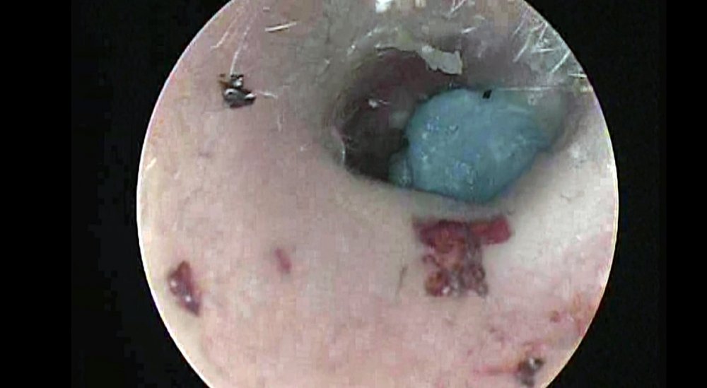 Kulaklardan çıkanlar hayrete düşürüyor