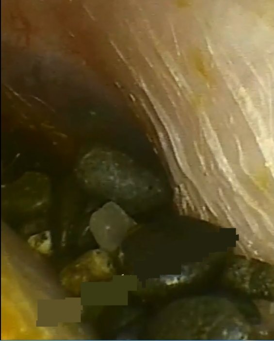 Kulaklardan çıkanlar hayrete düşürüyor